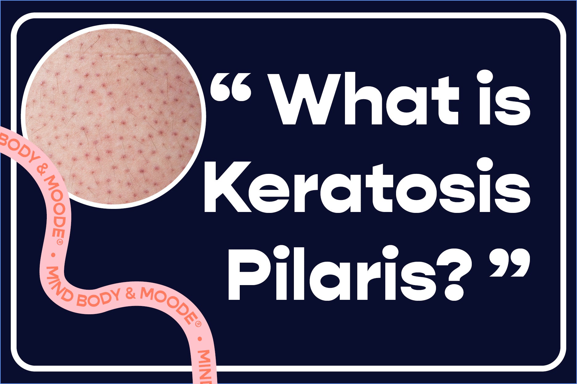 Keratosis Pilaris: What It Is And How To Treat It